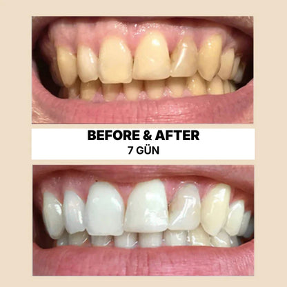 Doğal Diş Beyazlatma & Ağız Bakım Stick